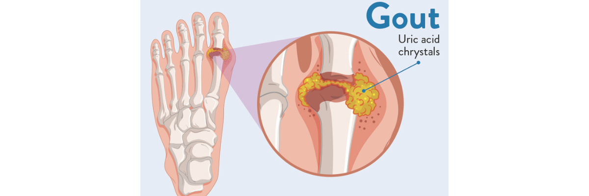 Gout Awareness